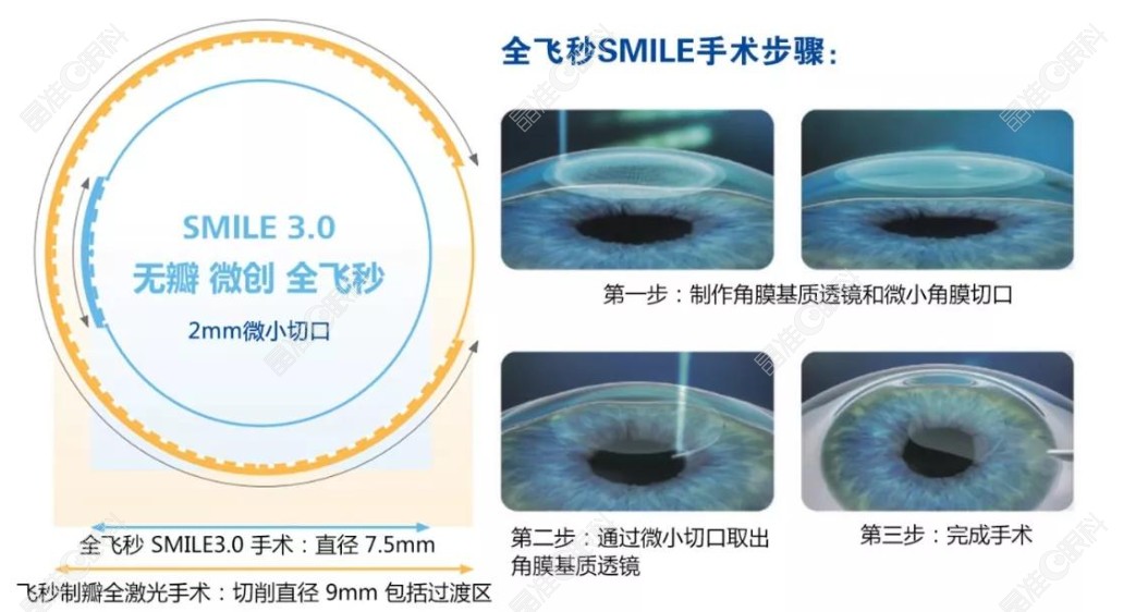 全飞秒手术过程和步骤