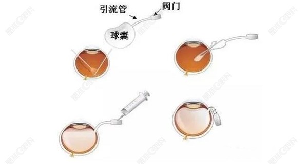 人工玻璃体球囊植入术www.ji-zhun.com