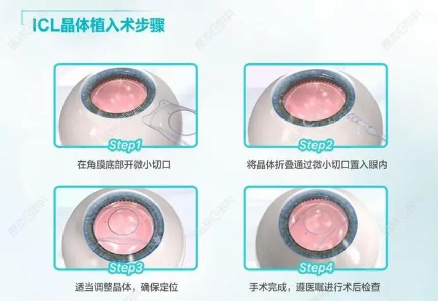 真人做ICL晶体植入手术分享