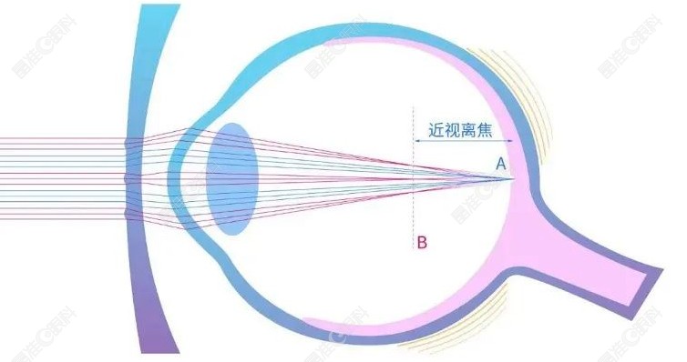新乐学镜片控制近视度数实例