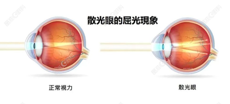近视散光手术多少钱?激光近视散光手术费用8K-2W