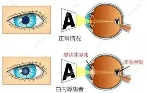 高度近视做晶体置换术