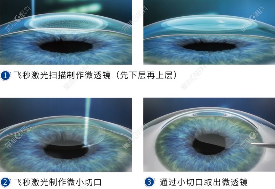 长沙博视眼科医院做近视手术好