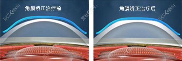 佩戴欧几里德ok镜矫正视力对比www.ji-zhun.com