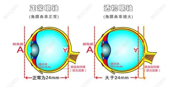 后巩膜加固术后注意事项有哪些