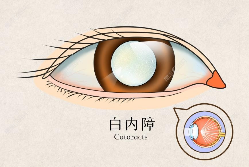 李建波白内障手术技术优势