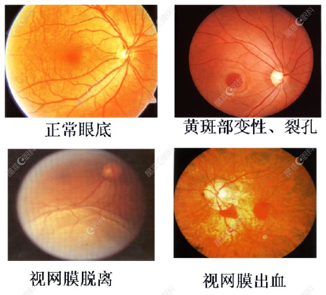 视网膜萎缩症状