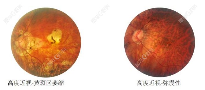 视网膜萎缩怎么治疗比较好