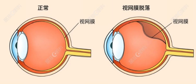 北京视网膜脱落费用多少钱 北京视网膜脱落费用多少钱