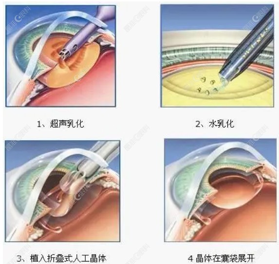 人工晶体植入手术过程www.ji-zhun.com