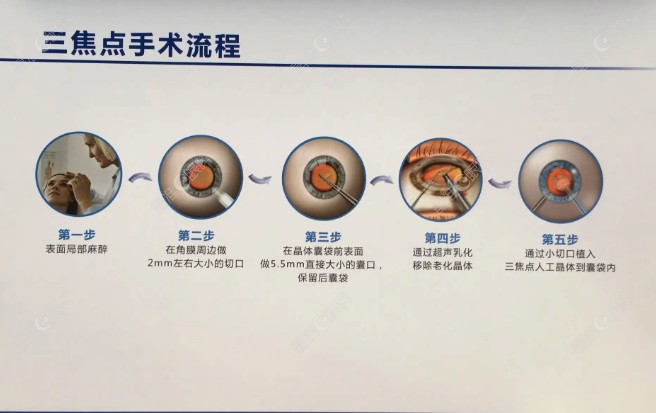 三焦人工晶体的缺点