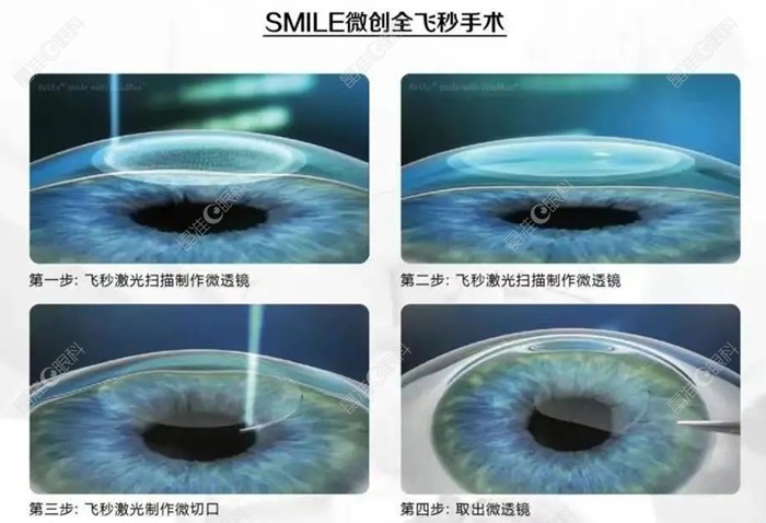 做全飞秒激光手术原理