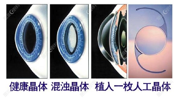 单焦点人工晶体的缺点是什么