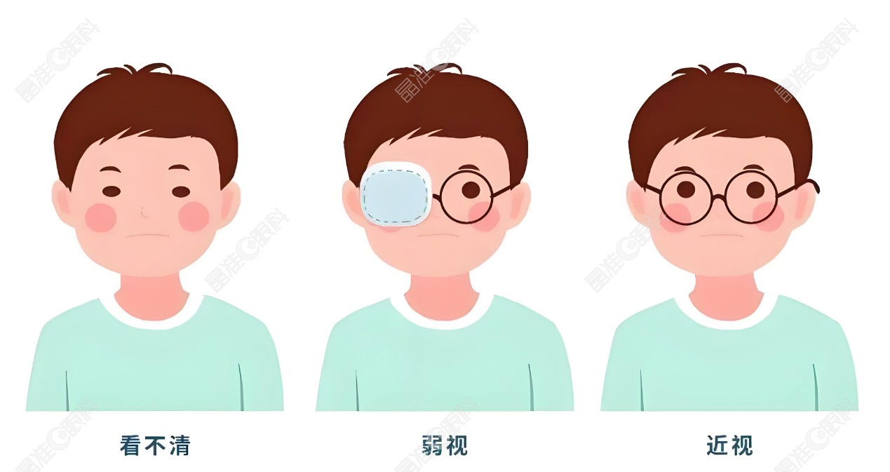 儿童近视矫正