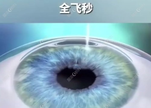 南京维视眼科医院近视手术做得好