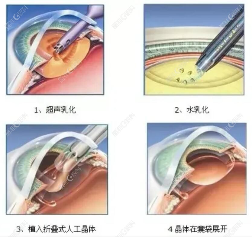 北京爱尔英智眼科医院做白内障好www.ji-zhun.com