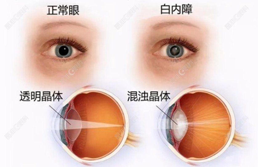 北京皓童明睿眼科给出的白内障眼睛对比