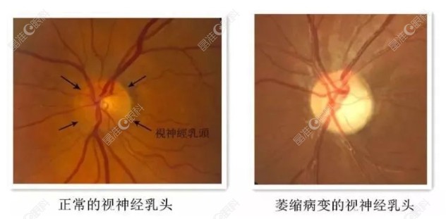 视神经萎缩
