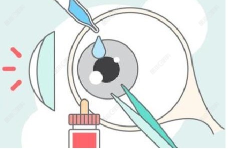 上海角膜塑形镜