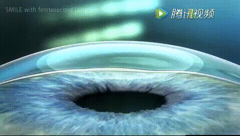 苏州太学眼科门诊部全飞秒
