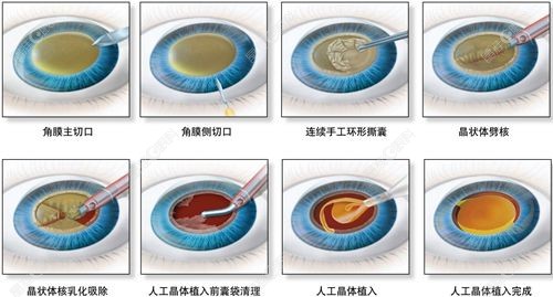 河南省立眼科医院白内障价格查询