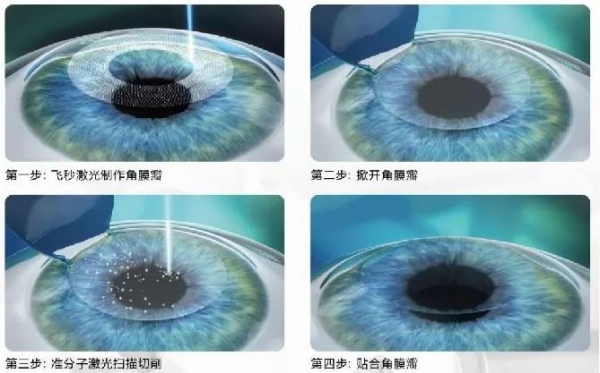 赣南医学院第一附属医院眼科飞秒