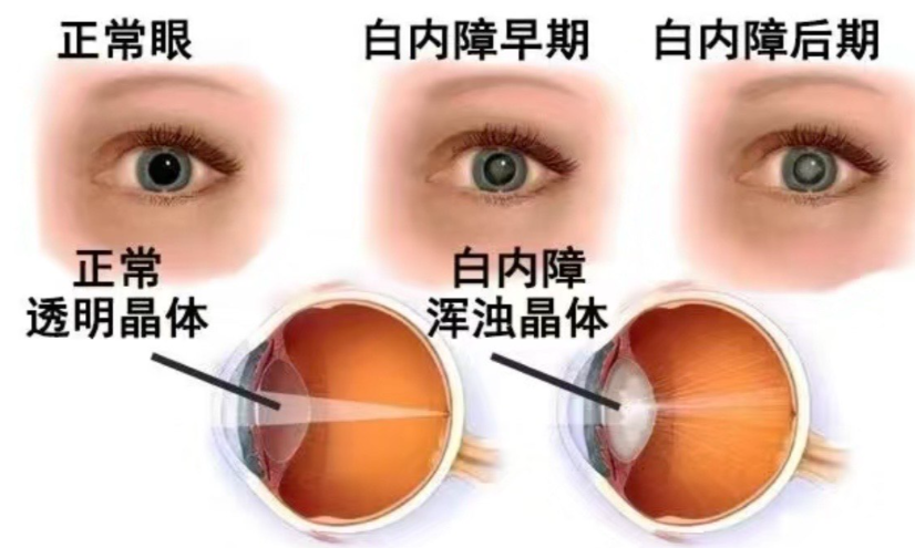 上海白内障免费手术有哪些注意事项