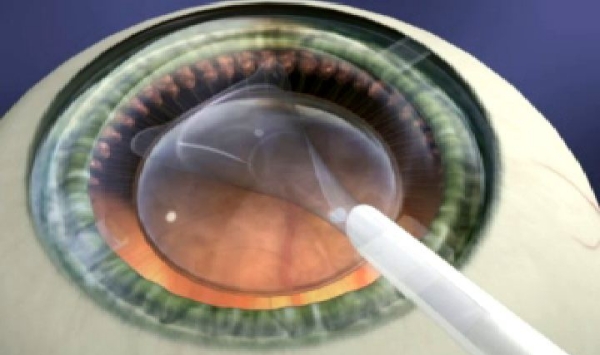 安顺光明眼科医院白内障手术费用