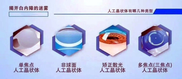 安顺光明眼科医院白内障晶体价格