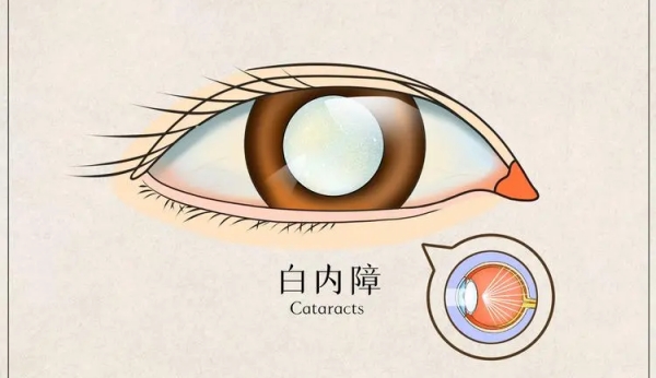 安顺光明眼科医院白内障费用