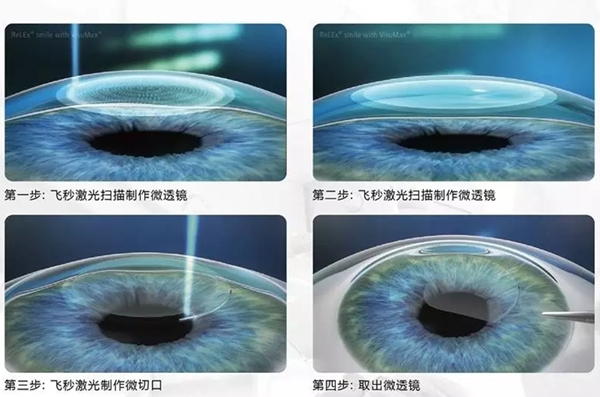 安顺光明眼科全飞秒价格