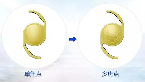 关于包头白内障手术免费政策的常见问题解答